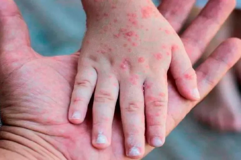 África lucha contra la viruela del mono