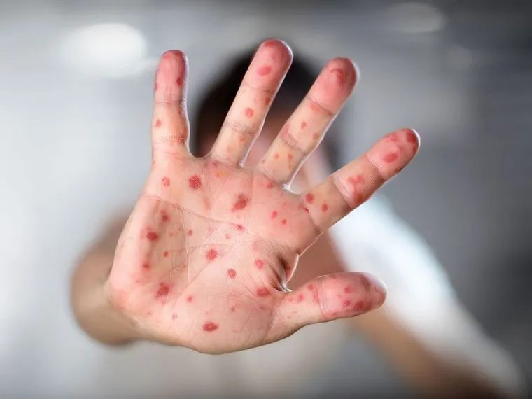 Confirmaron un caso autóctono de viruela del mono en Argentina