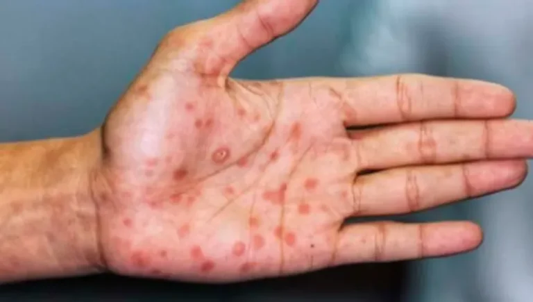 Detectan más casos de viruela del mono 